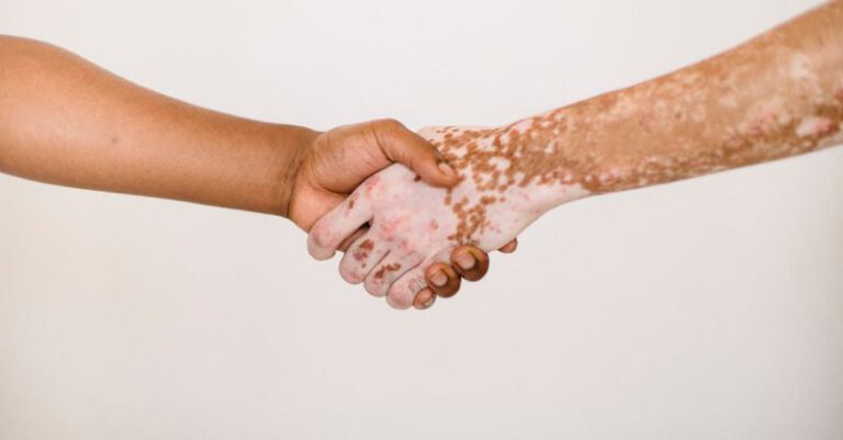 Integrate - Crop anonymous man shaking hand of male friend with vitiligo skin against white background